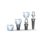 بهترین نوع ایمپلنت دندان چیست؟