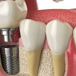 اجزای ایمپلنت دندان چیست؟| مراحل نصب اجزای ایمپلنت