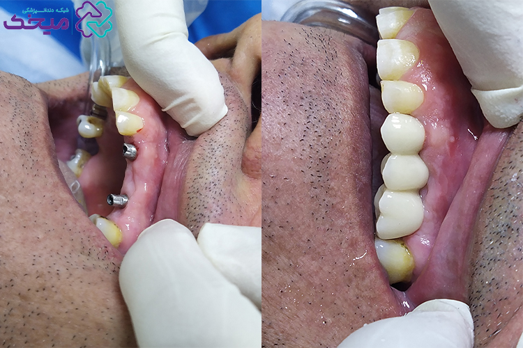 نمونه‌کار ایمپلنت دندان۳