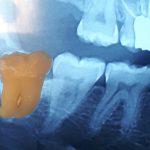 کشیدن دندان عقل چگونه است؟ + هزینه کشیدن دندان عقل