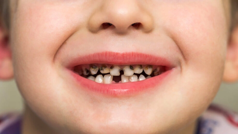 پوسیدگی دندان کودکان چگونه درمان می‌شود؟