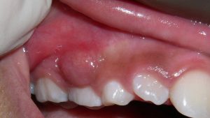 ابسه دندان چیست
