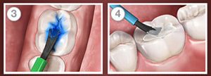 مراحل کامپوزیت دندان با عکس