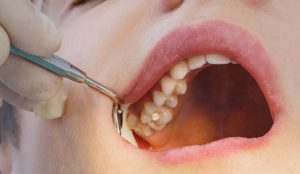 مراقبت بعد از کشیدن دندان عقل پایین
