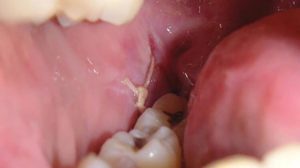 عفونت بعد از کشیدن دندان عقل