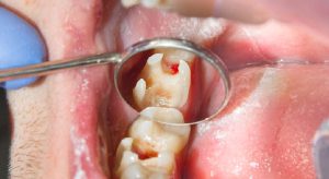 علائم عصب کشی دندان