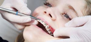 مراحل ارتودنسی دندان با عکس