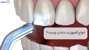 انواع کامپوزیت دندان