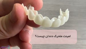 لمینت متحرک دندان چیست؟