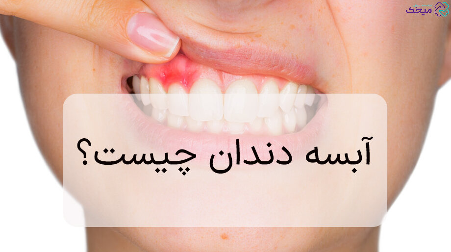 آبسه دندان چیست