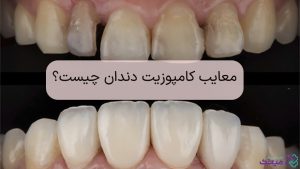 معایب کامپوزیت دندان