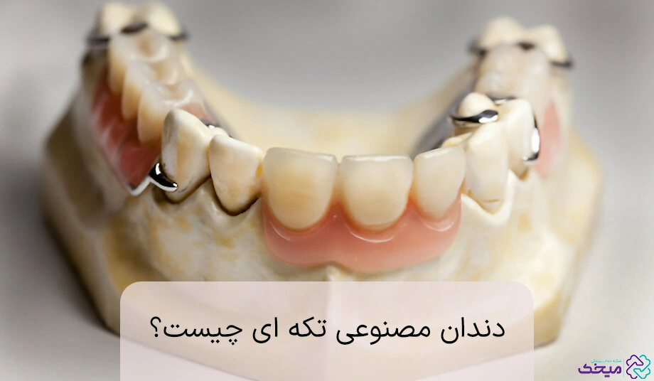 دندان مصنوعی تکه ای چیست