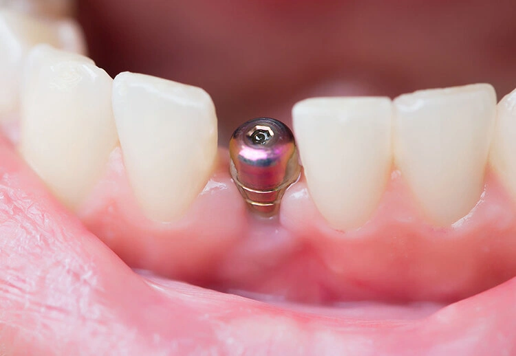 چه مدت بعد از کشیدن دندان باید ایمپلنت کرد