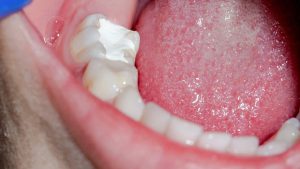 پانسمان دندان چیست