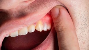 درمان آبسه دندان چیست