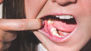 علائم عفونت دندان پس از کشیدن چیست