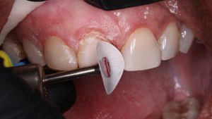 پالیش کامپوزیت دندان چیست