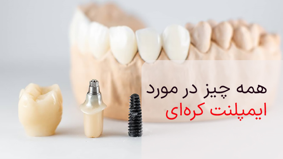 ایمپلنت کره ای
