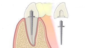 پست دندان چیست؟