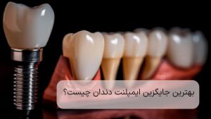 جایگزین ایمپلنت دندان چیست؟