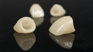 انواع روکش دندان چیست