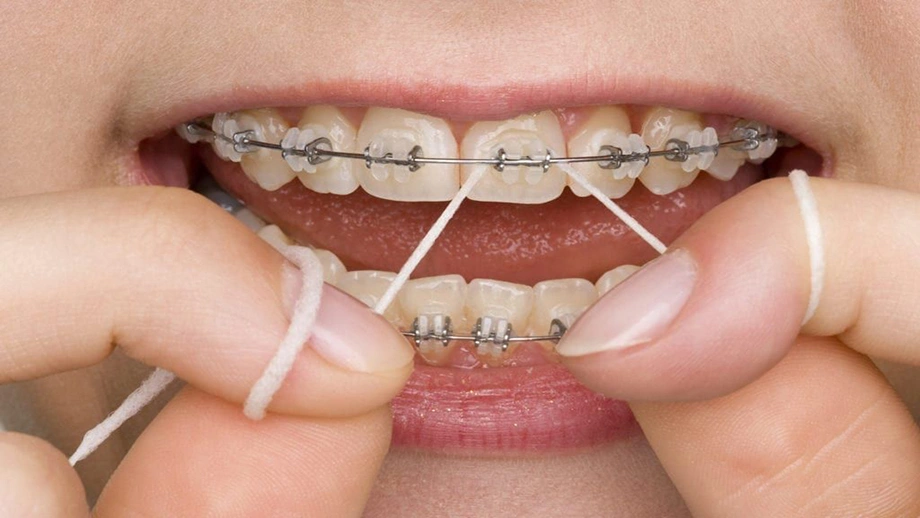 نخ دندان ارتودنسی چه ویژگی های دارد؟