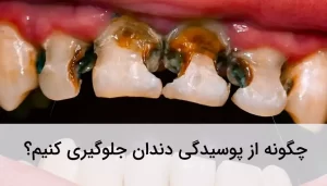 پوسیدگی دندان یکی از عوامل خرابی دندان است.