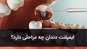 مراحل ایمپلنت دندان شامل 7 گام متفاوت است.