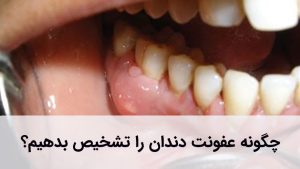 عفونت دندان علت‌ها و علائم متفاوتی دارد.