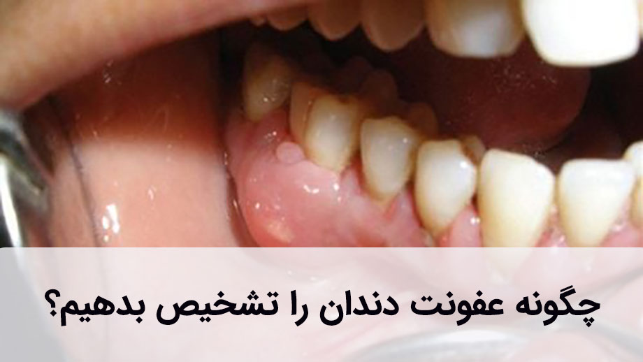 عفونت دندان علت‌ها و علائم متفاوتی دارد.