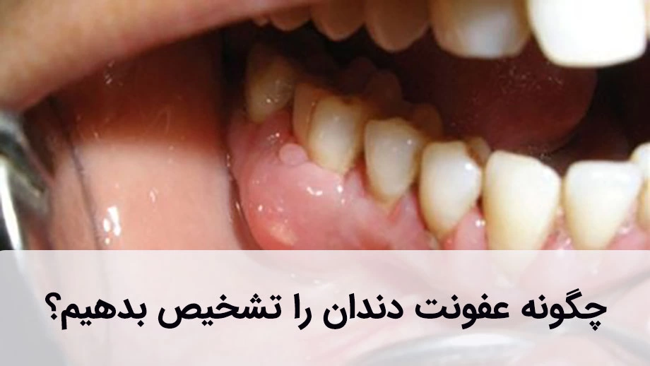 عفونت دندان علت‌ها و علائم متفاوتی دارد.