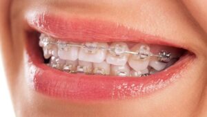 ارتودنسی دندان چیست