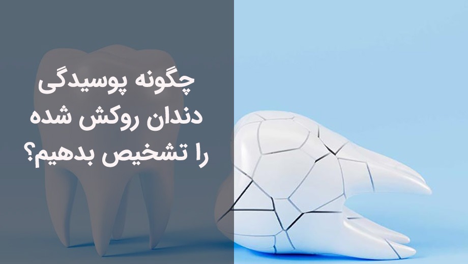 پوسیدگی دندان روکش شده، باید توسط دندانپزشک بررسی شود.