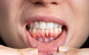 عفونت ژنژیویت لثه یکی از انواع عفونت لثه است.
