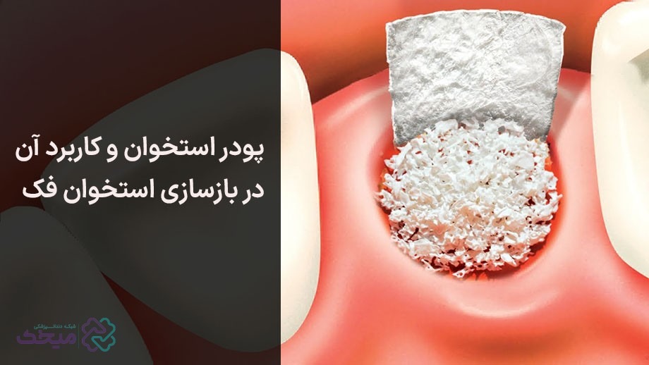 پودر استخوان برای بازسازی استخوان به کار می‌رود.