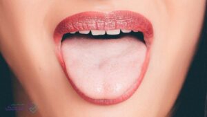 علائم همراه با تلخی دهان شامل خشکی و سوزش است.