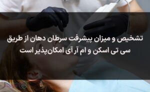 سرطان دهان 3 مدل متفاوت است.