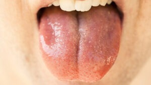 مصرف اسپری‌های مرطوب کننده باعث از بین رفتن خشکی دهان می‌شود.