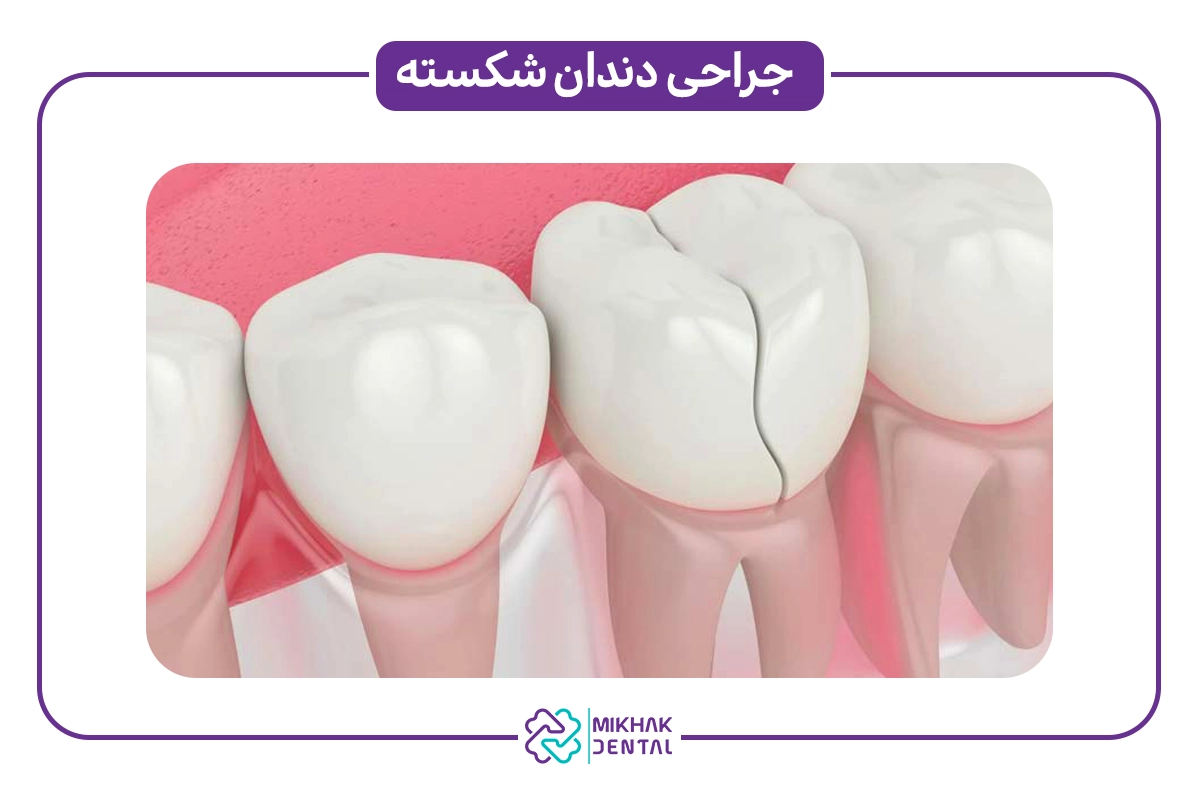 مزایا جراحی دندان شکسته