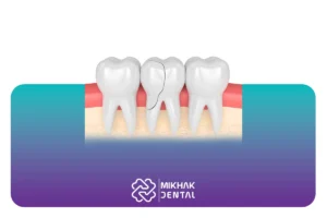 جراحی دندان شکسته