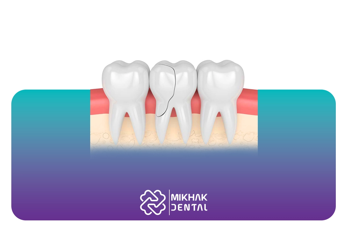 جراحی دندان شکسته