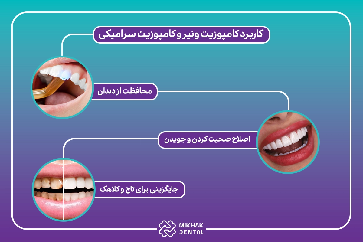 کامپوزیت ونیر بهتر است یا کامپوزیت سرامیکی