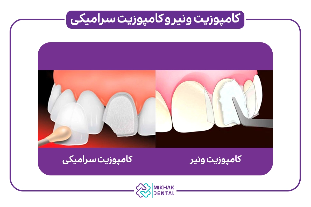 تفاوت ونیر سرامیکی و کامپوزیتی در ماندگاری