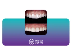 تفاوت کامپوزیت ونیر و کامپوزیت سرامیکی