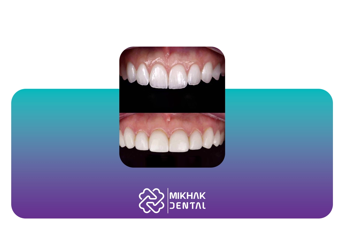 تفاوت کامپوزیت ونیر و کامپوزیت سرامیکی