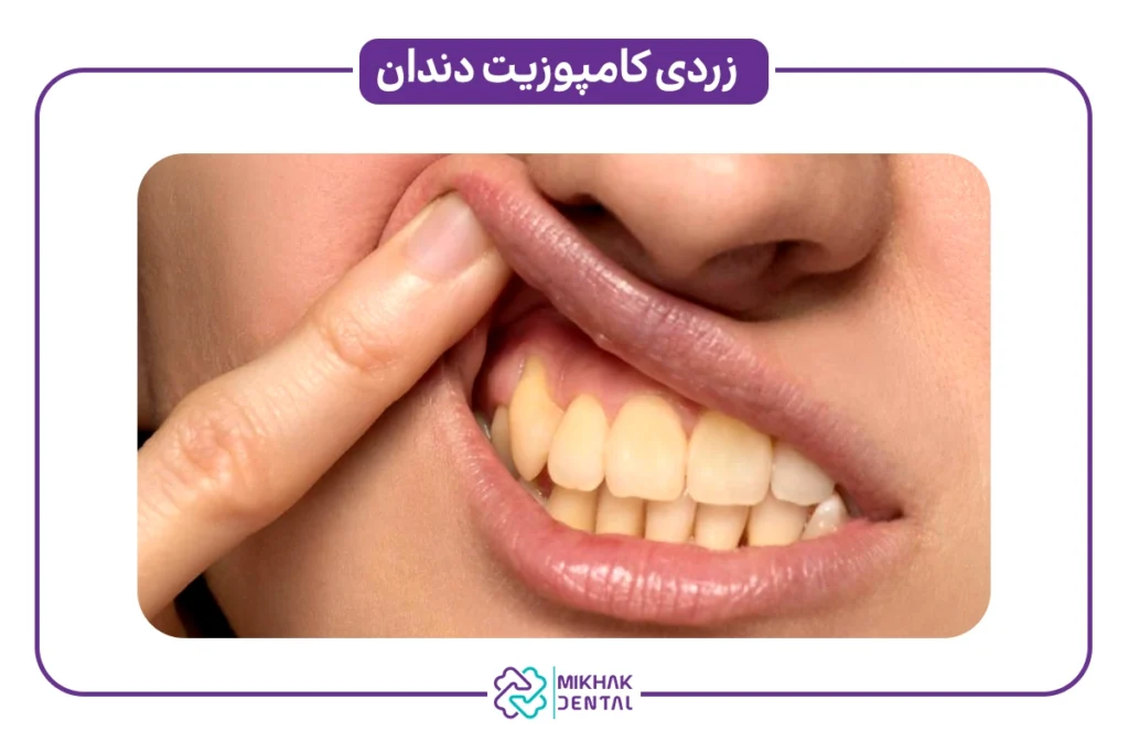 رفع زردی کامپوزیت دندان