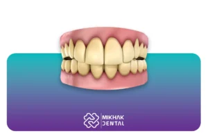 زرد شدن کامپوزیت دندان