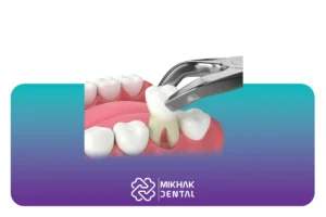 بهترین مسکن بعد از کشیدن دندان