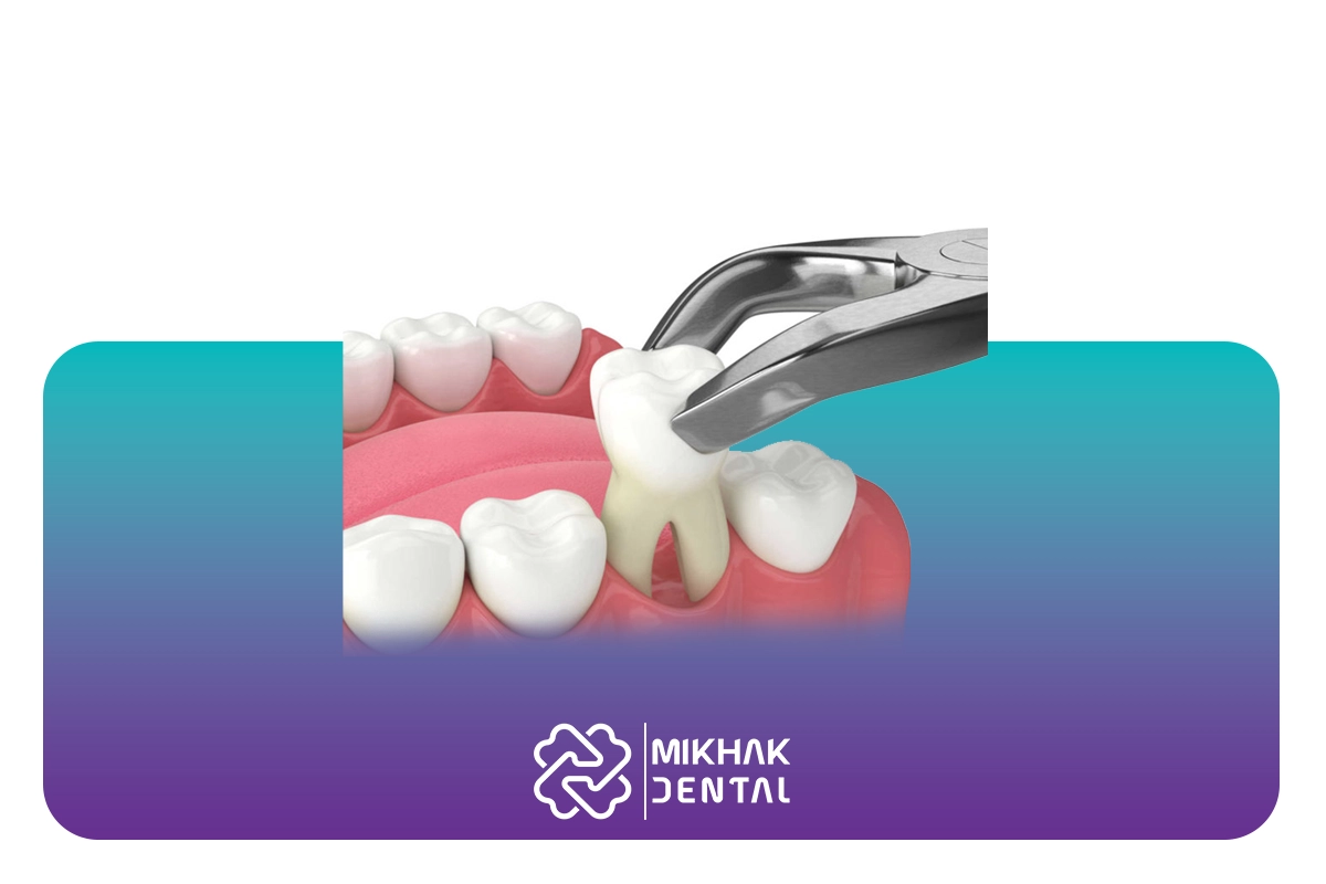 بهترین مسکن بعد از کشیدن دندان